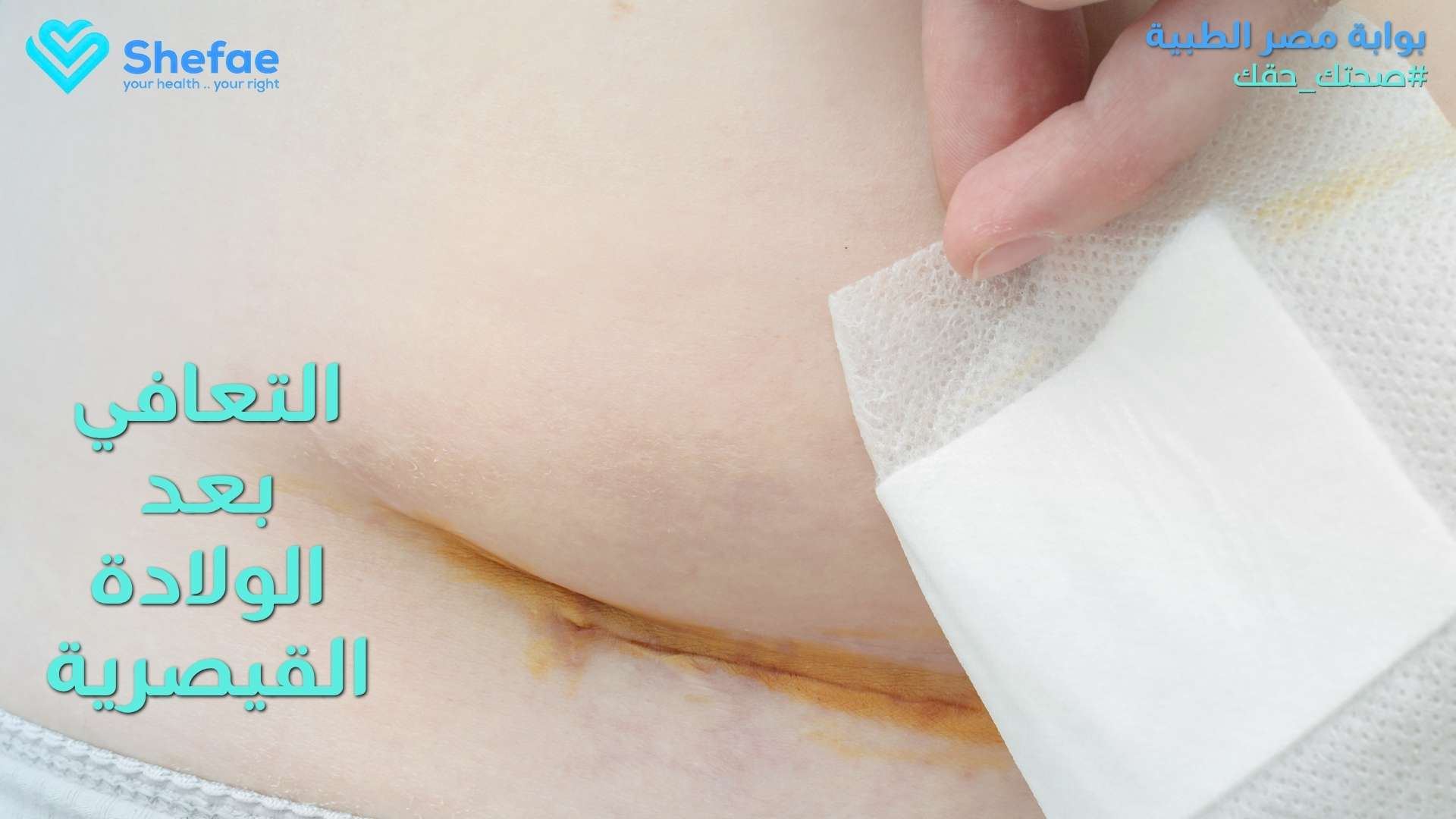 التعافي بعد الولادة القيصرية: خطوات ونصائح لتسريع الشفاء